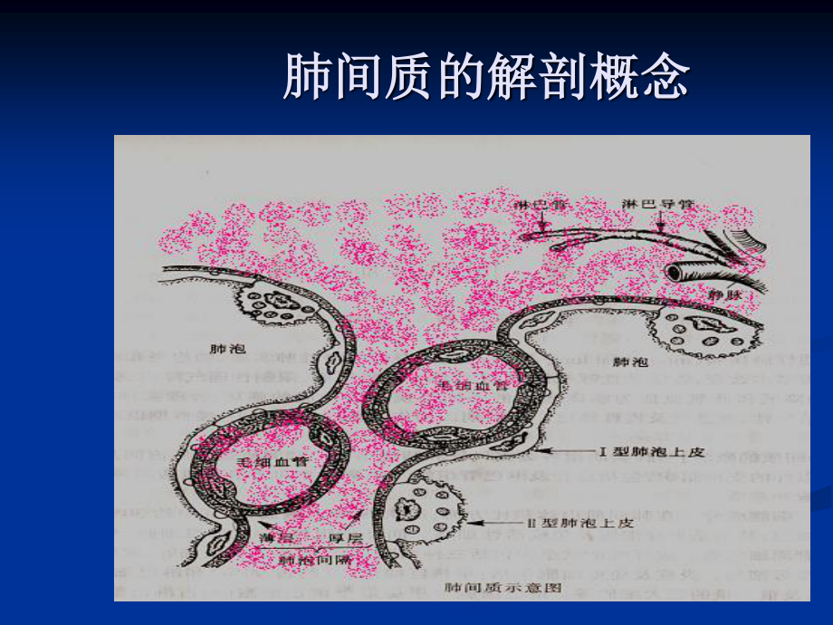 4-特发性肺纤维化.ppt_第3页