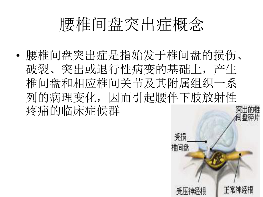 腰突症的针刀精准诊疗.pptx_第2页