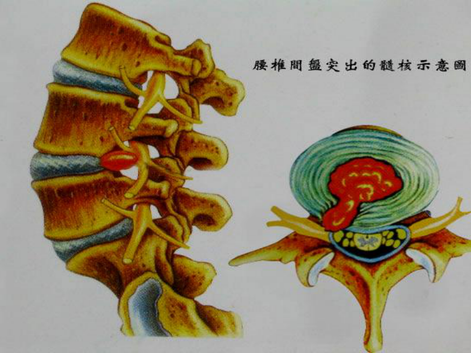 腰突症的针刀精准诊疗.pptx_第3页