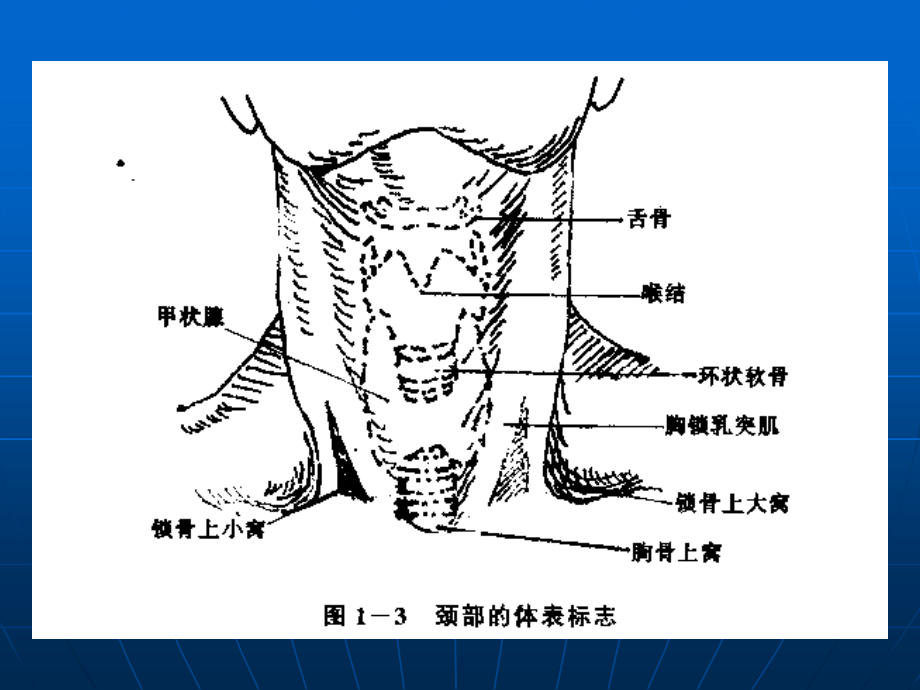 锁骨下深静脉穿刺.ppt_第3页