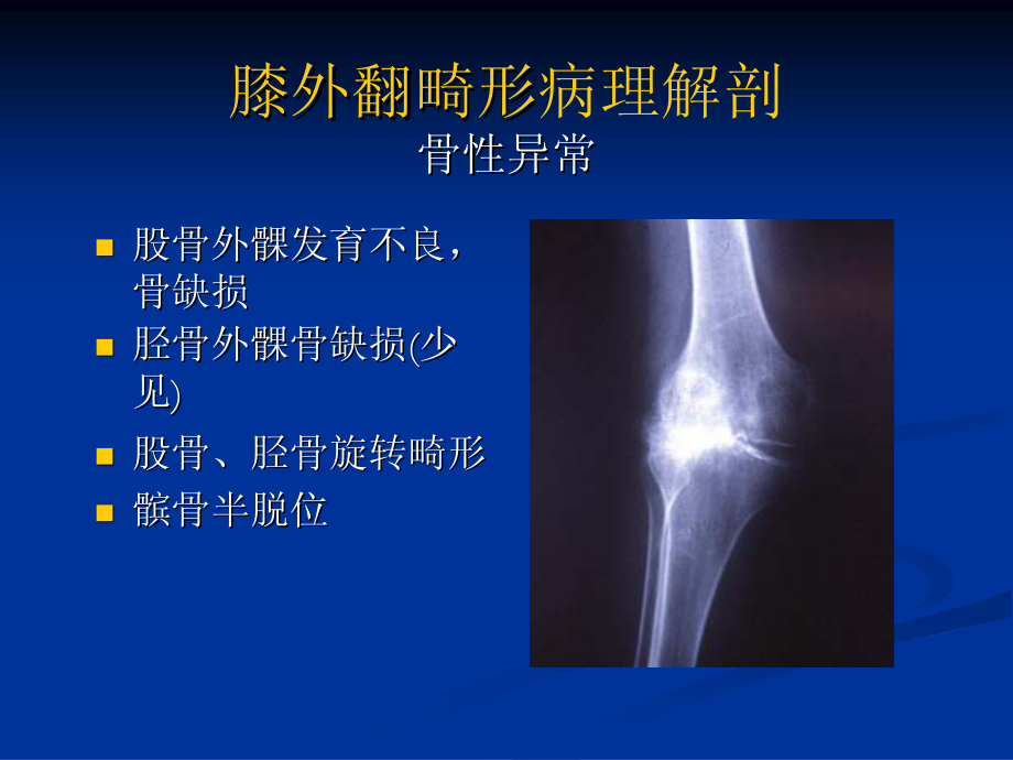 膝外翻畸形全膝关节置换剖析.pdf_第3页