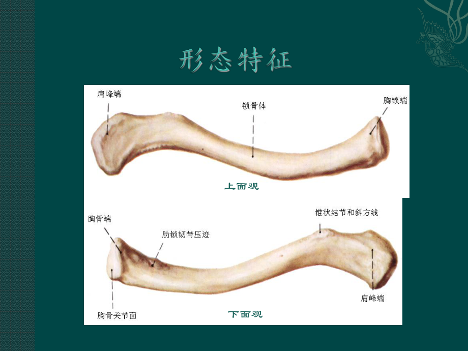 锁骨骨折.ppt_第3页