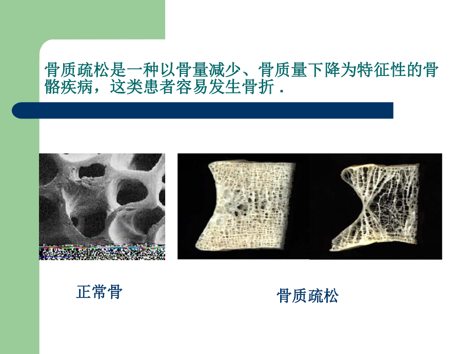 浅谈骨质疏松椎体压缩骨折.ppt_第2页