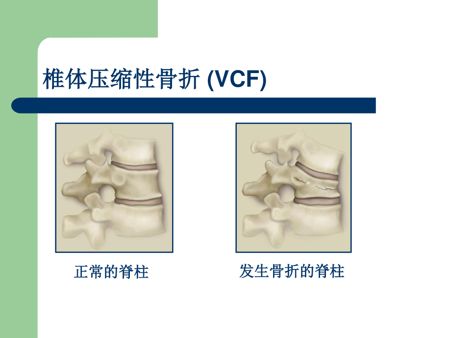 浅谈骨质疏松椎体压缩骨折.ppt_第3页