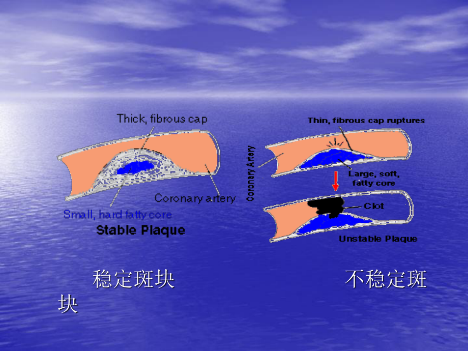 急性心肌梗死急诊教学详解.ppt_第3页