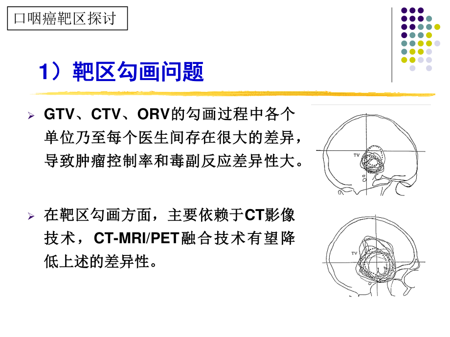 口腔癌精确放疗.ppt_第3页