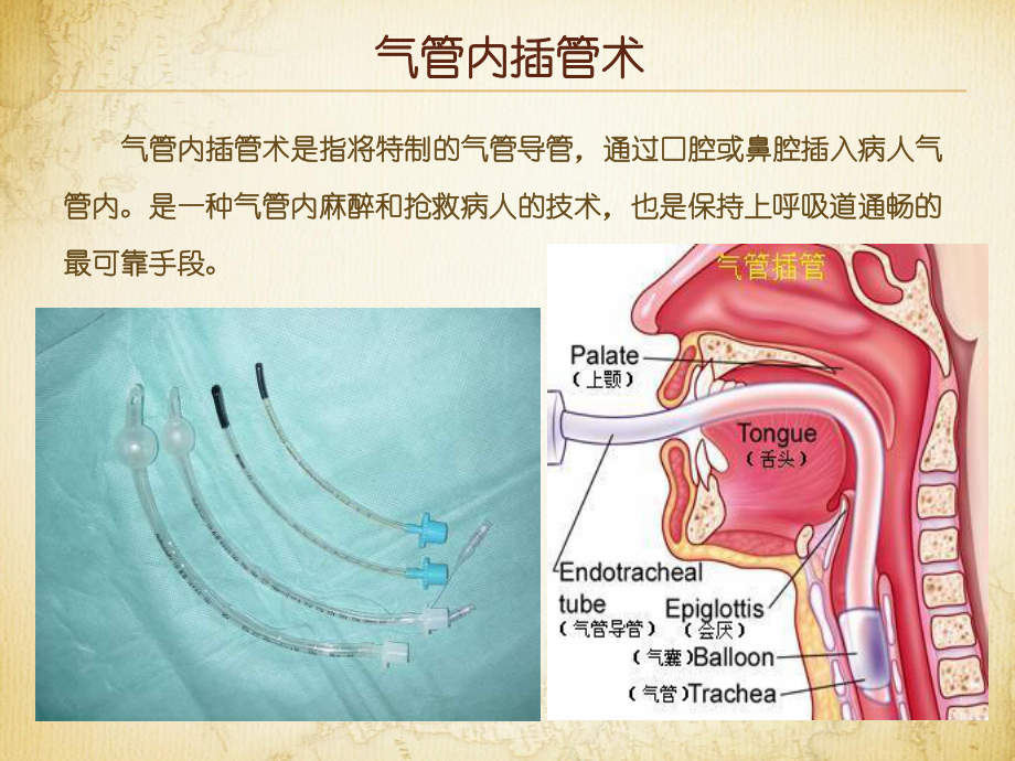 气管内插管术与气管切开术.ppt_第2页