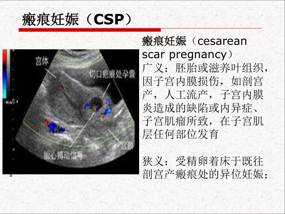 子宫瘢痕妊娠...ppt_第2页