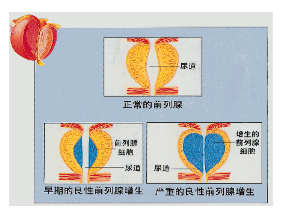 药综-十四章-前列腺增生症.ppt_第3页