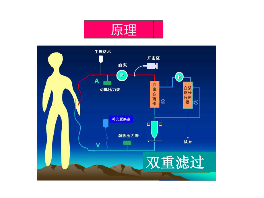 双重滤过血浆置换不良反应及处理.ppt_第2页