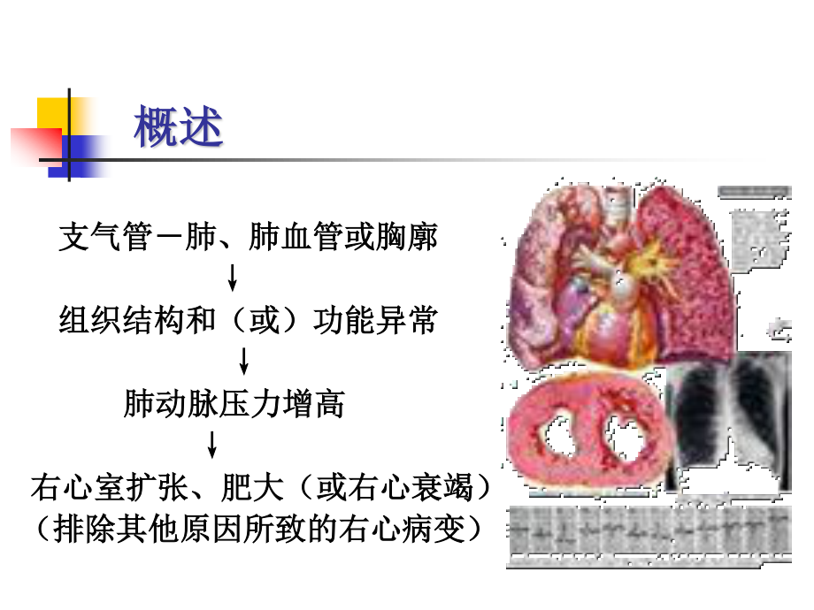 慢性肺源性心脏病讲解.ppt_第3页