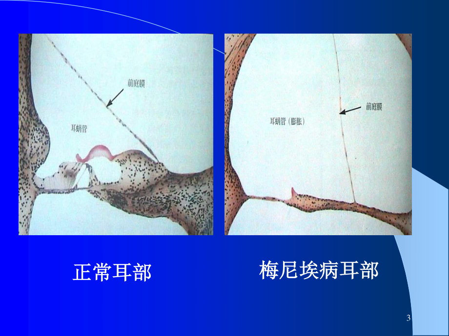 梅尼埃病及耳聋防治(2014)剖析.ppt_第3页