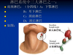 淋巴风暴-ding.ppt