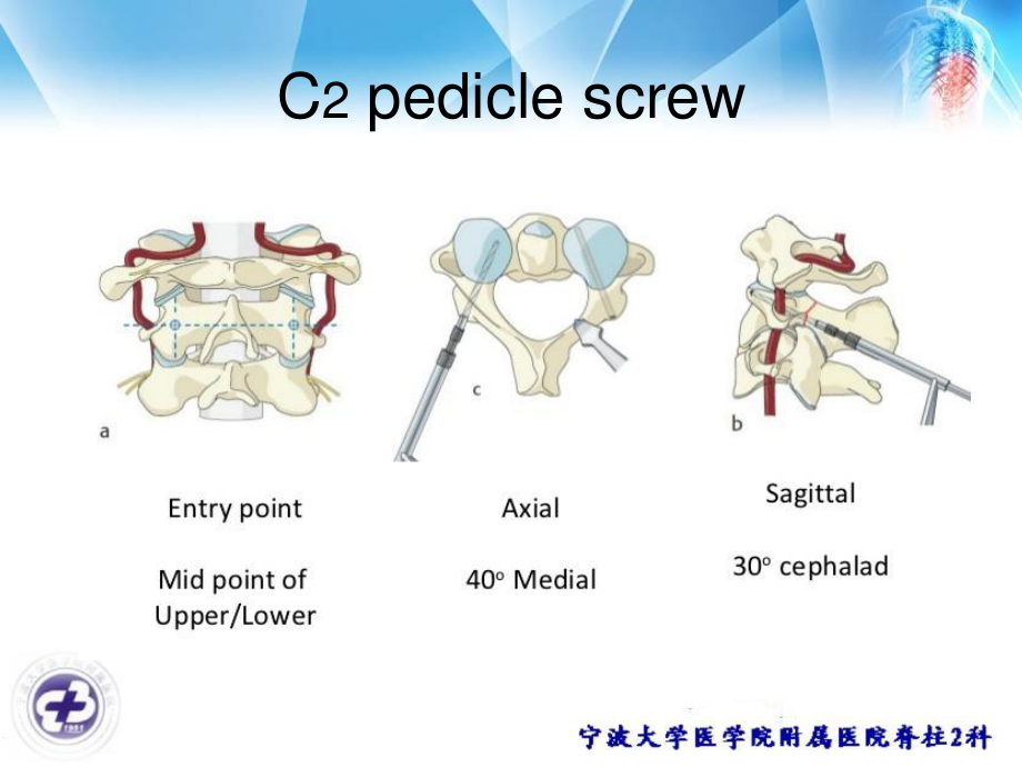 椎动脉高跨和颈2椎板螺钉.ppt_第2页