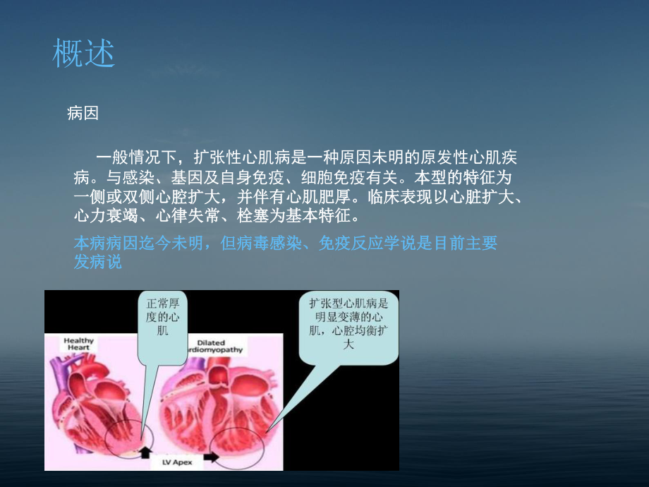 扩张型心肌病.pptx_第3页