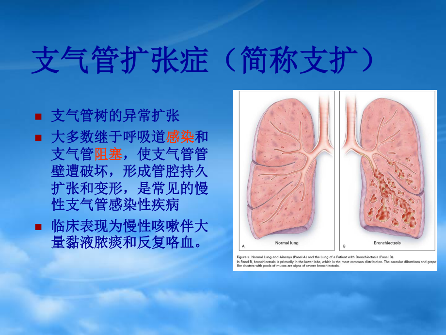 支气管扩张bronchiectasis.ppt_第2页