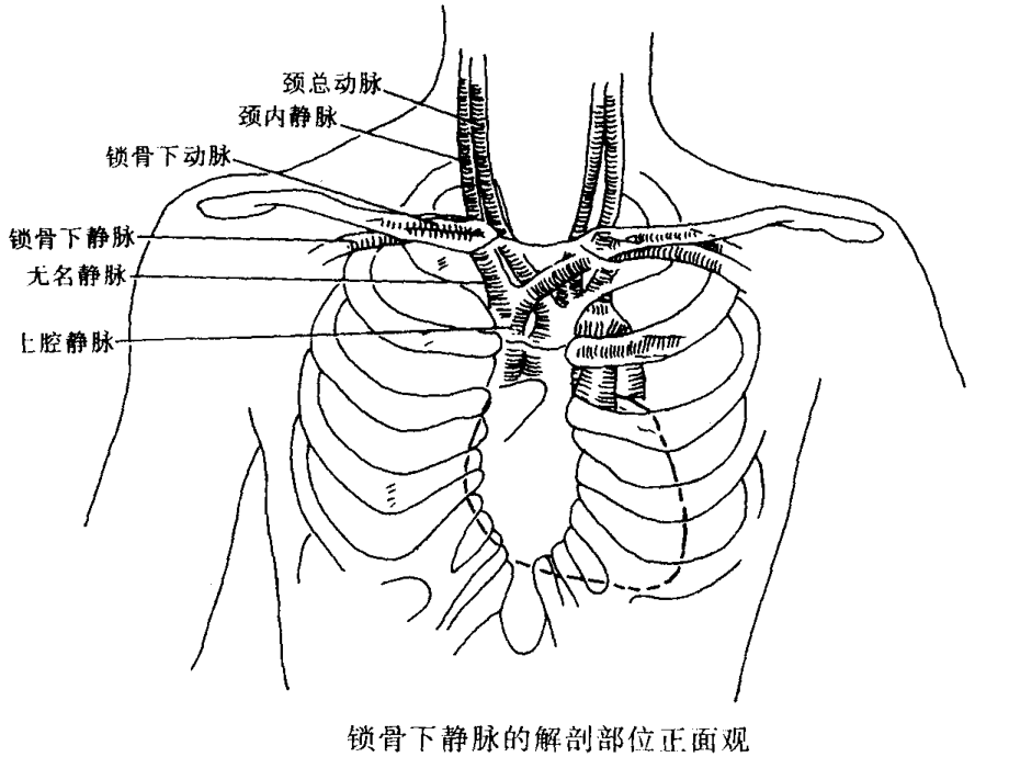 锁骨下静脉穿刺置管术修改后.ppt_第3页