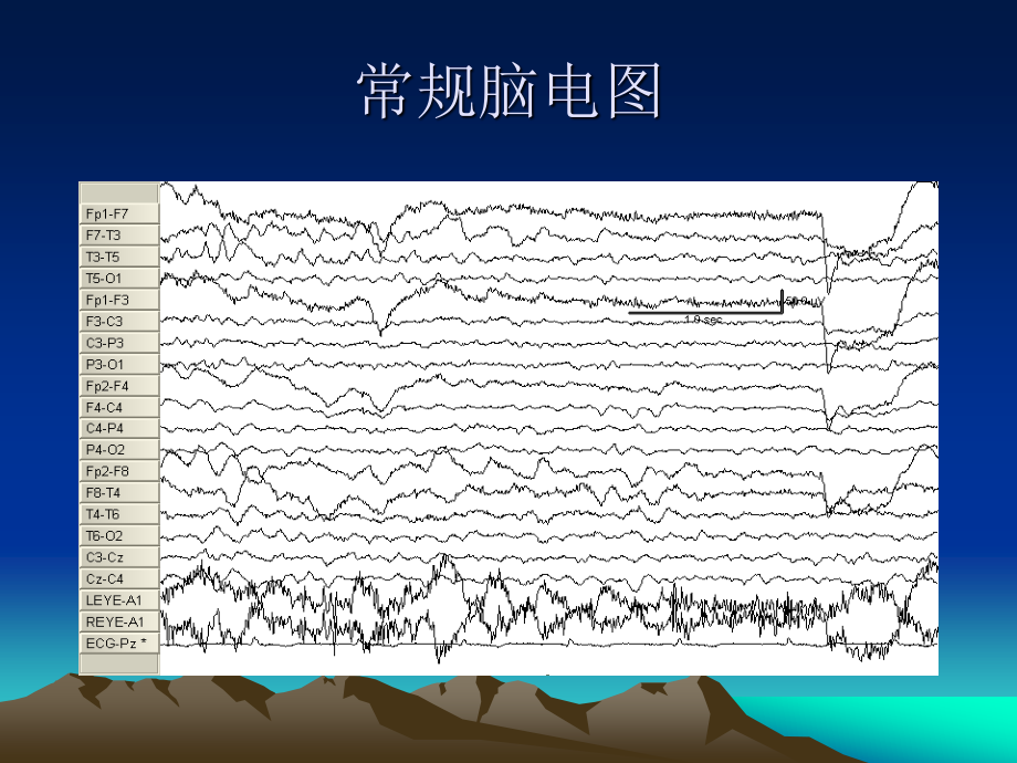 振幅整合脑电-卢伟能.ppt_第3页