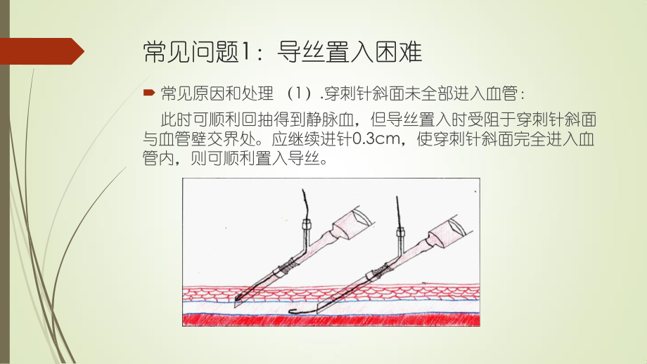 锁骨下静脉穿刺-常见问题(周三小讲课).pptx_第3页