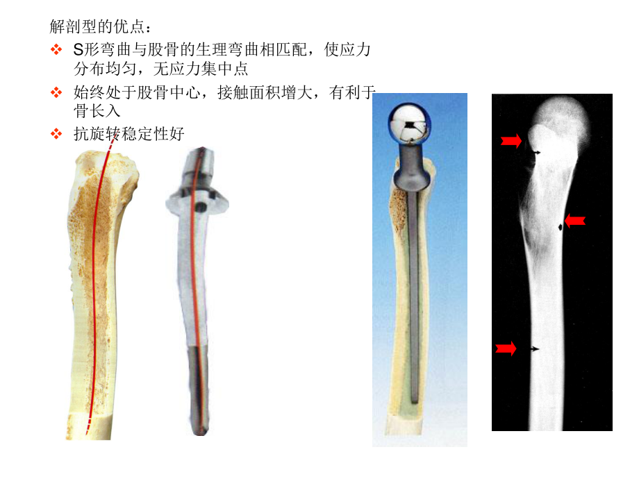 常用髋关节假体类.ppt_第3页