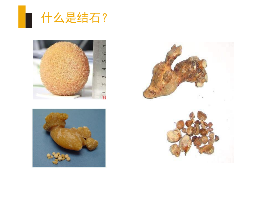 输尿管镜钬激光碎石宣教.ppt_第2页