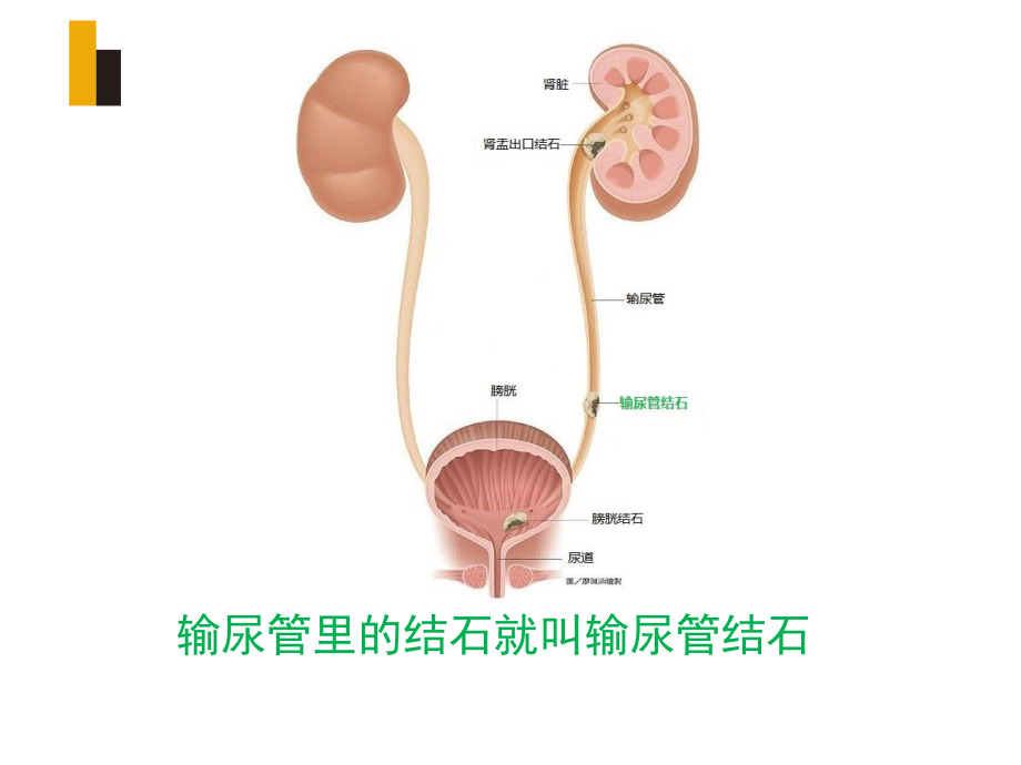 输尿管镜钬激光碎石宣教.ppt_第3页