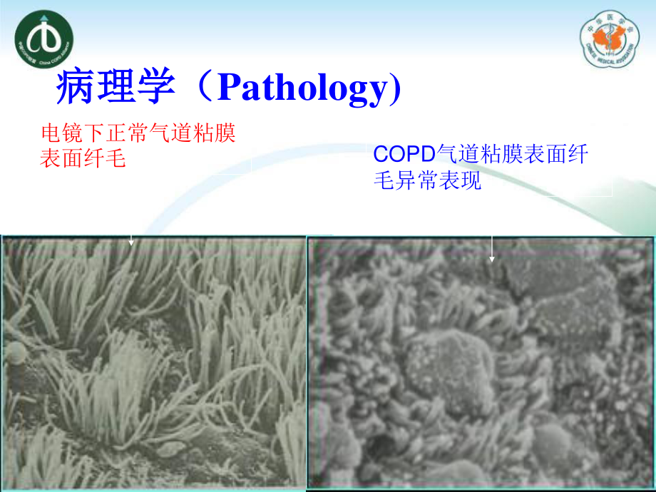 慢性支气管炎10.9班.ppt_第3页