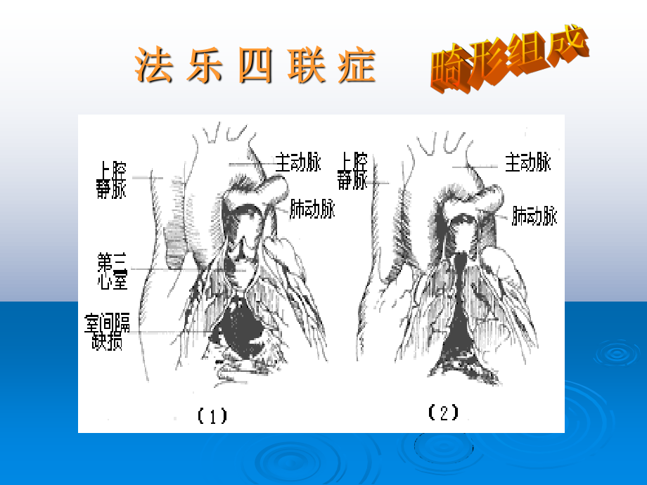 法洛四联症..ppt_第3页