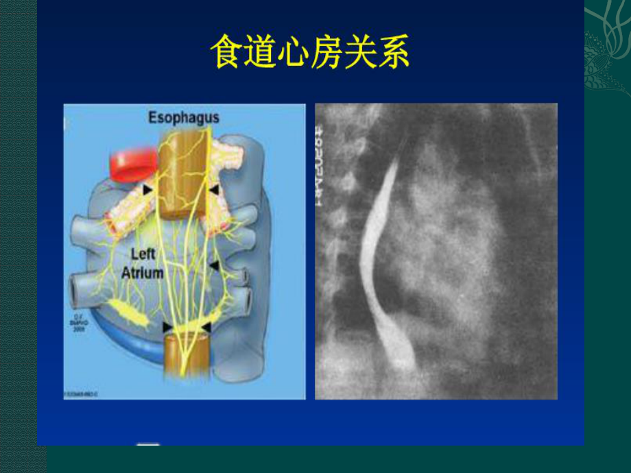 食道调搏术(精美ppt).pptx_第3页