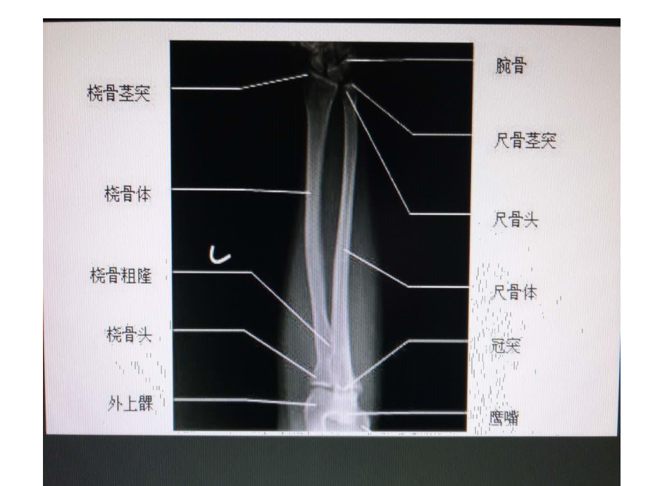 尺桡骨干双骨折的.ppt_第3页