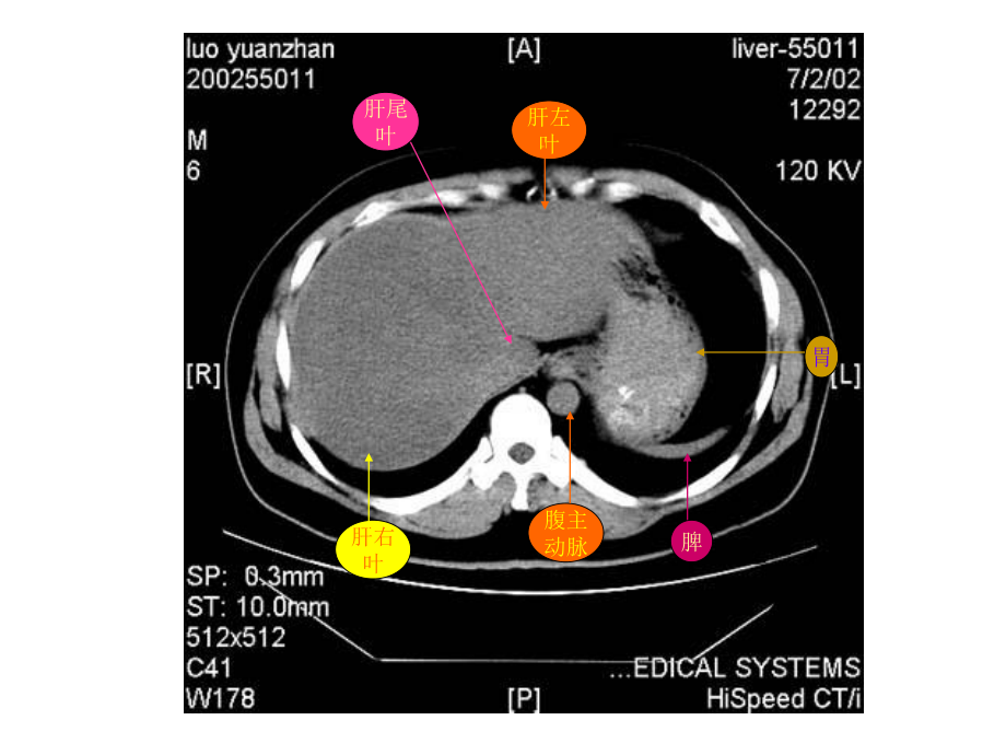教你认识腹部CT.ppt_第3页
