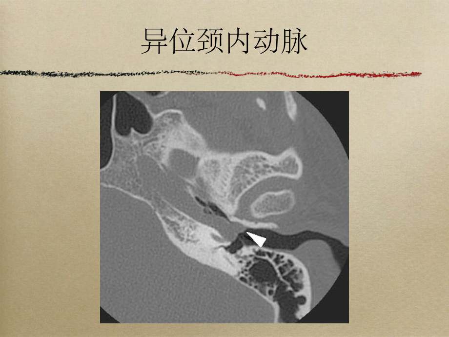 搏动性耳鸣的影像表现.ppt_第2页