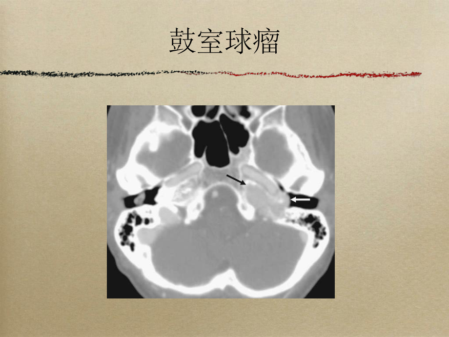 搏动性耳鸣的影像表现.ppt_第3页