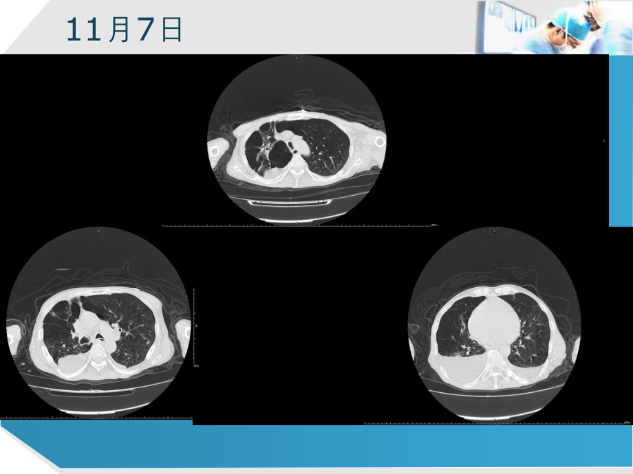 感染性心内膜炎并发急性肺栓塞一例-2015IE.ppt_第3页