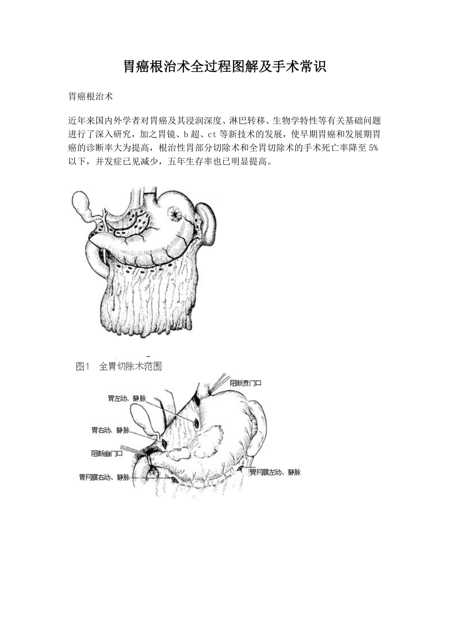 胃癌根治术全过程图解及手术常识.doc_第1页