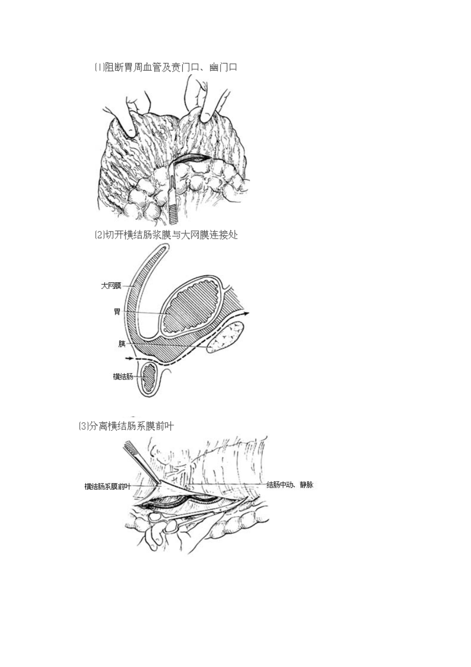 胃癌根治术全过程图解及手术常识.doc_第2页