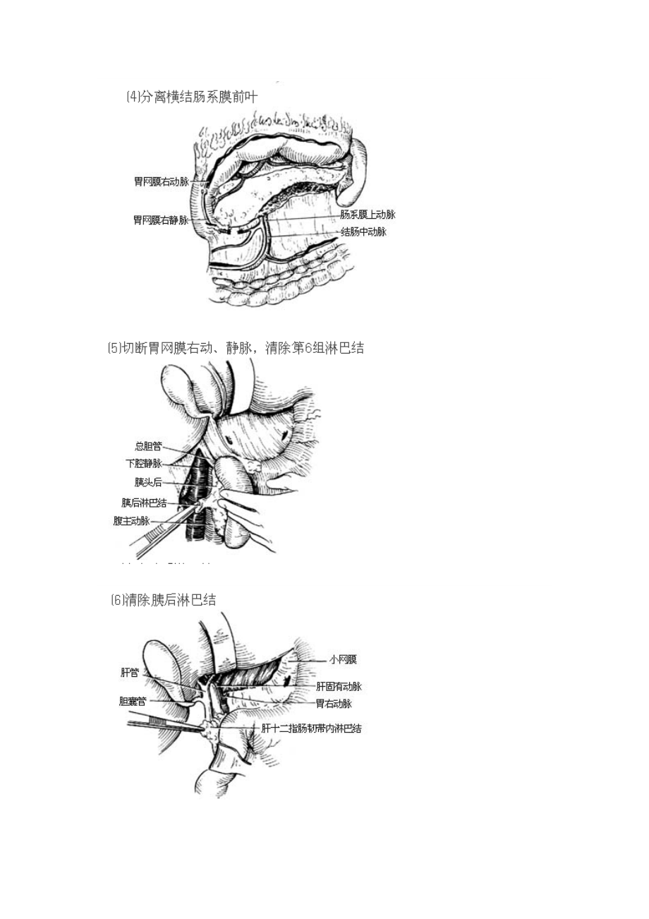 胃癌根治术全过程图解及手术常识.doc_第3页