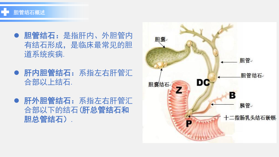 周梦娜-胆总管结石.pptx_第3页