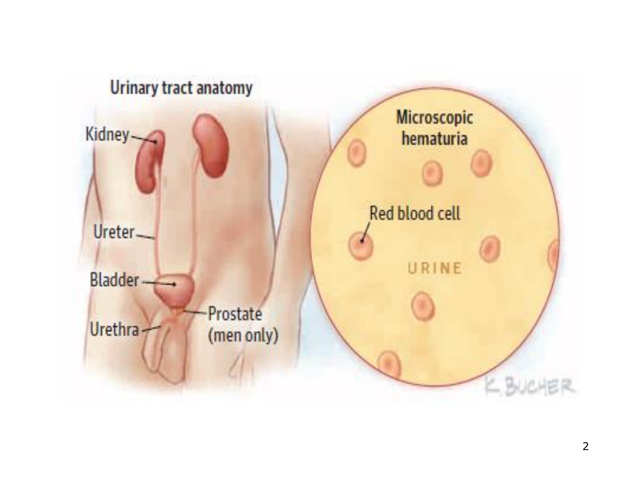 血尿-孙佳.pptx_第2页