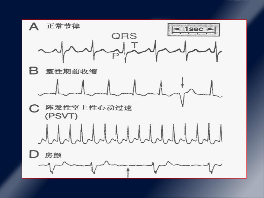 抗心律失常药1.ppt_第3页