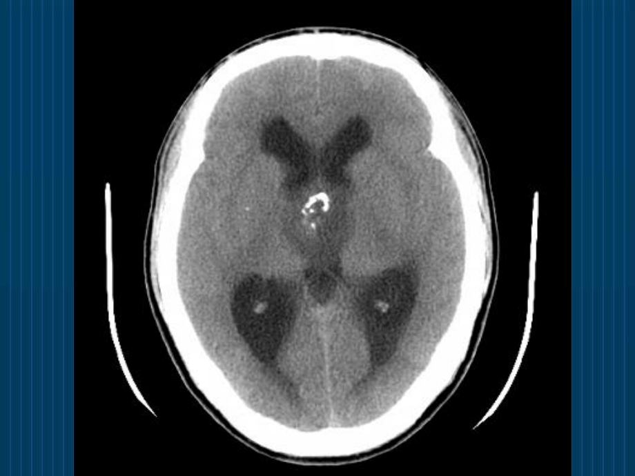 怎么看头颅CT与MRI.ppt_第3页