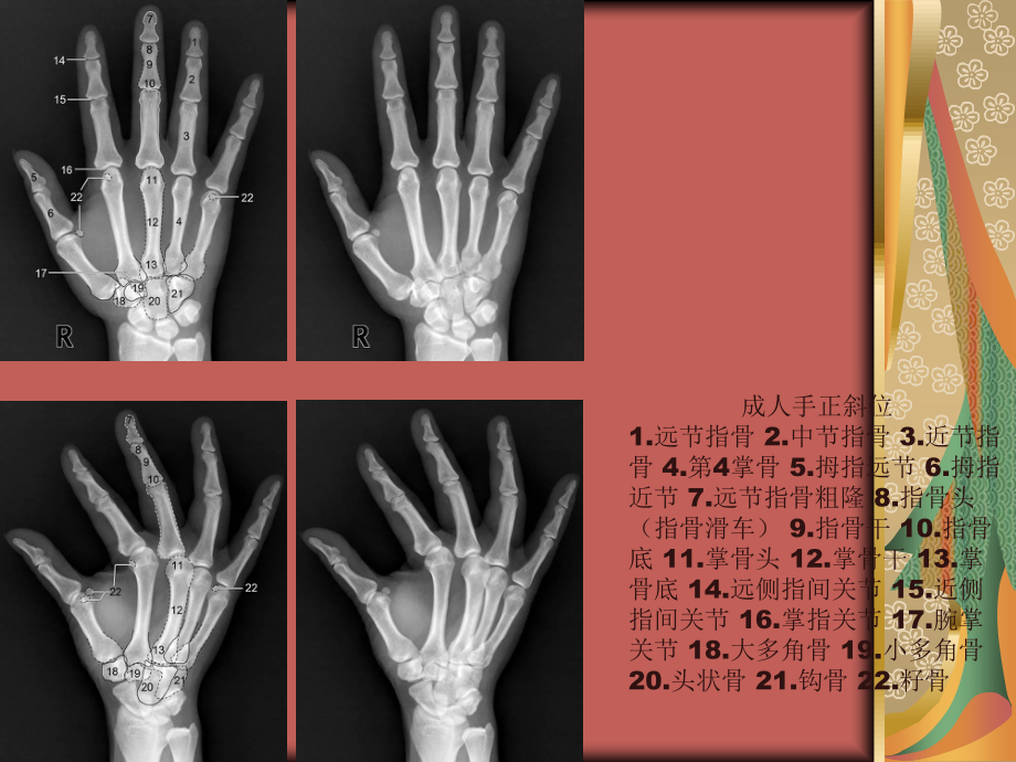 四肢关节正常变异、常见病变及创伤的影像表现.ppt_第3页