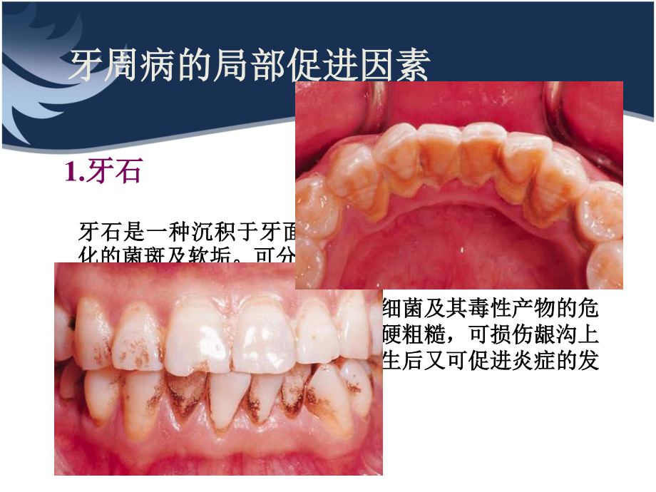 牙周病的局部及全身促进因素.ppt_第3页