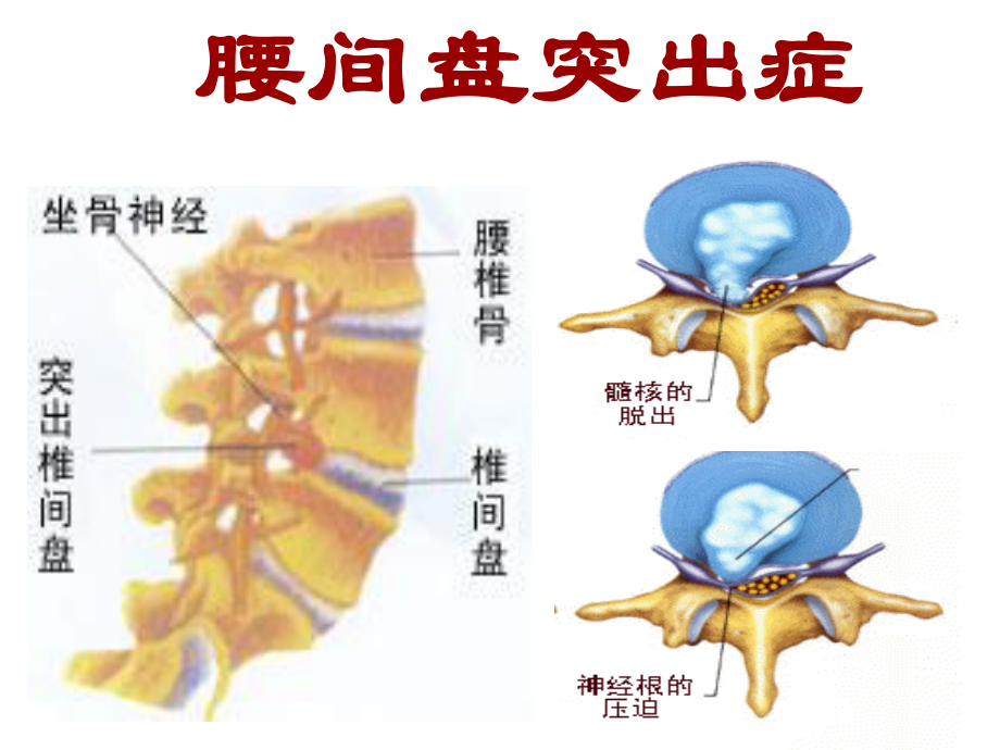 腰间盘突出症1.ppt_第3页