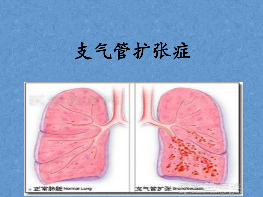 支气管扩张2018.ppt_第1页