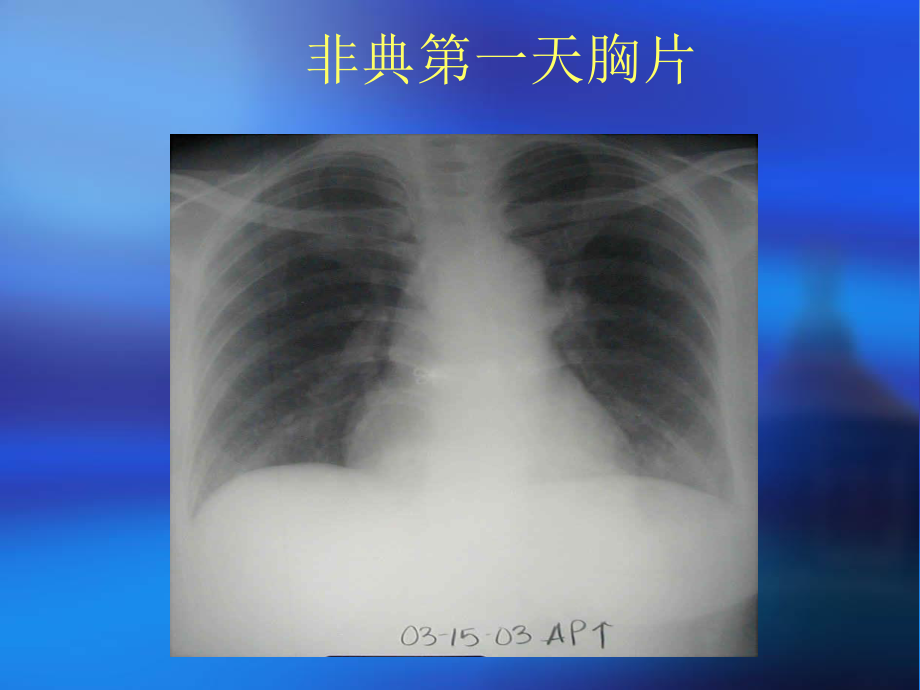 急性肺损伤和急性呼吸窘迫.ppt_第1页