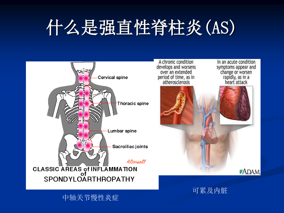 强直性脊柱炎及其伴发的葡萄膜炎.ppt_第2页