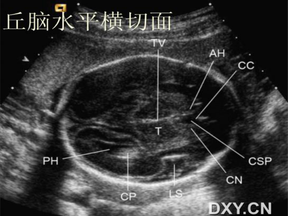 胎儿超声标准切面.ppt_第3页