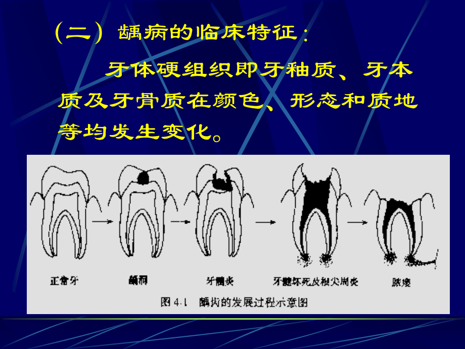 牙体牙髓常见病龋病.ppt_第3页