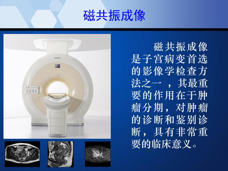 子宫内膜癌的MRI表现.ppt_第2页